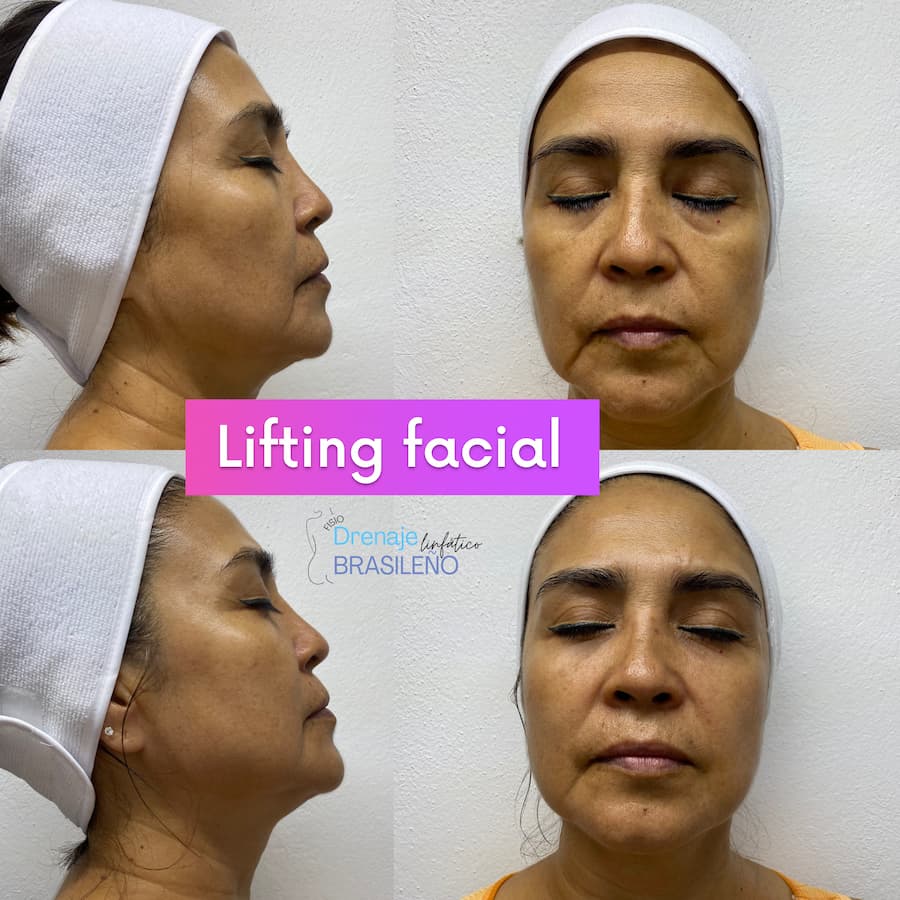Comparación de una mujer antes y después del lifting facial, demostrando los beneficios del Lifting Facial, en el tratamiento del Drenaje Linfático Brasileño